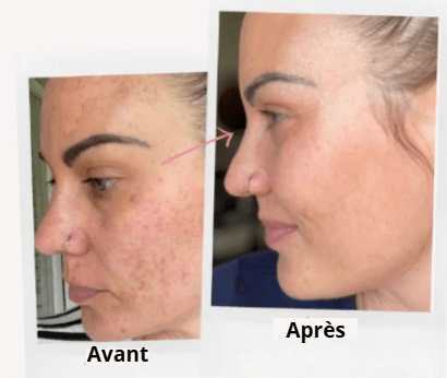 Tampons Exfoliants Curcuma & Acide Kojic