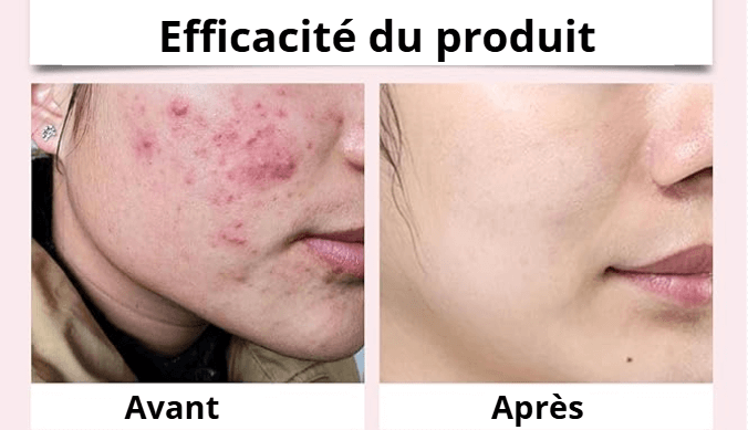 Tampons Exfoliants Curcuma & Acide Kojic