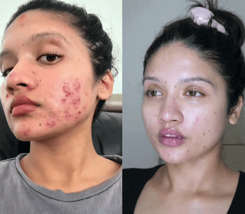 Tampons Exfoliants Curcuma & Acide Kojic