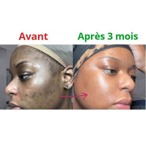 Tampons Exfoliants Curcuma & Acide Kojic