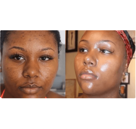 Tampons Exfoliants Curcuma & Acide Kojic